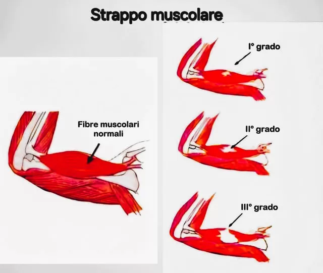 Strappo muscolare